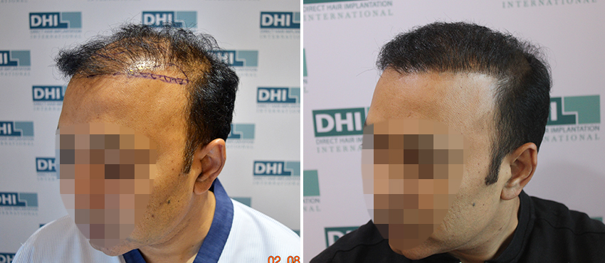 DHI before & after hair transplant results