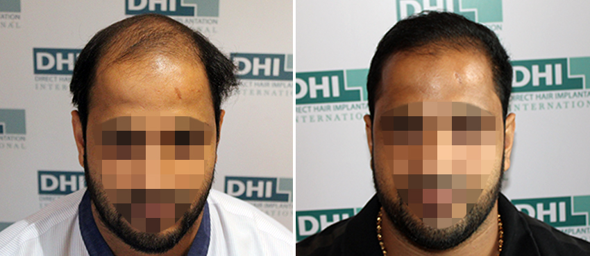 DHI before & after hair transplant results