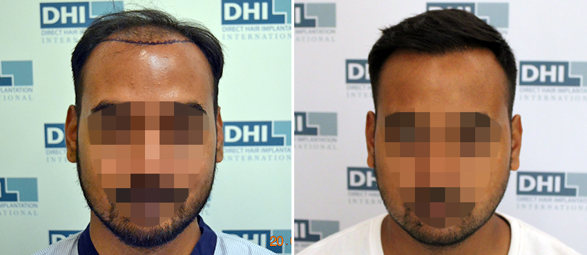 DHI before & after hair transplant results