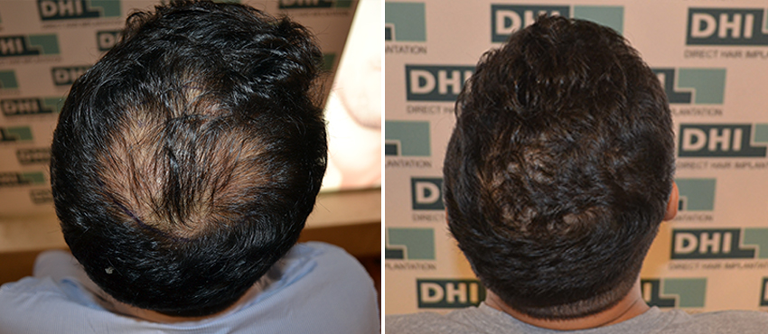 DHI before & after hair transplant results