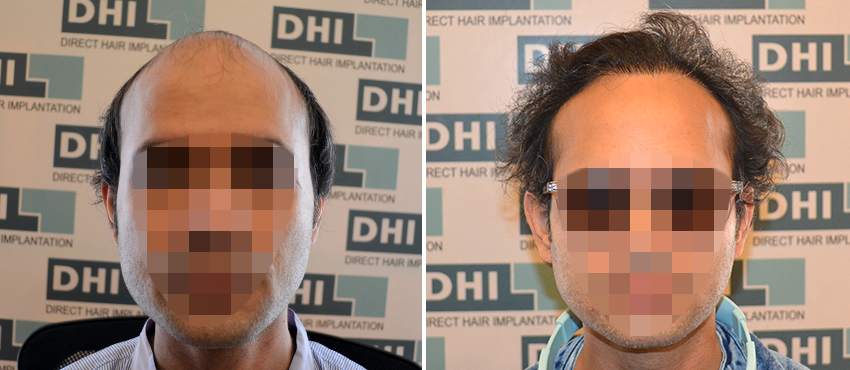 DHI before & after hair transplant results