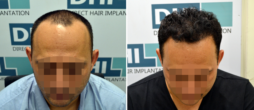 DHI before & after hair transplant results