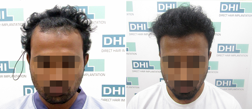 DHI before & after hair transplant results