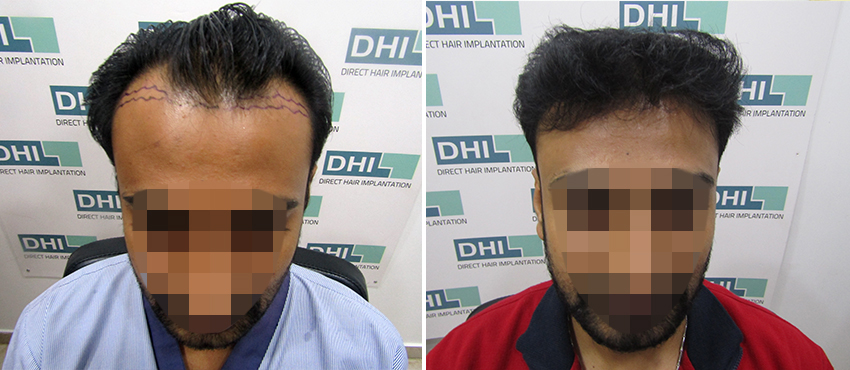 DHI before & after hair transplant results