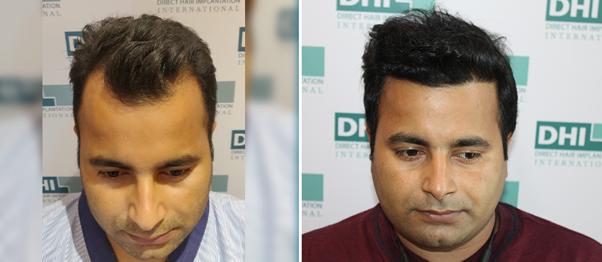 DHI before & after hair transplant results