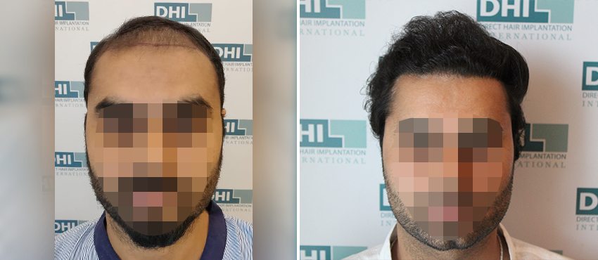 DHI before & after hair transplant results