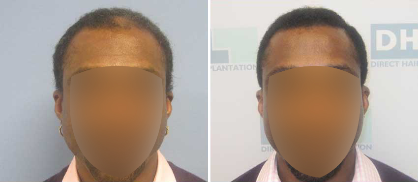 DHI before & after hair transplant results