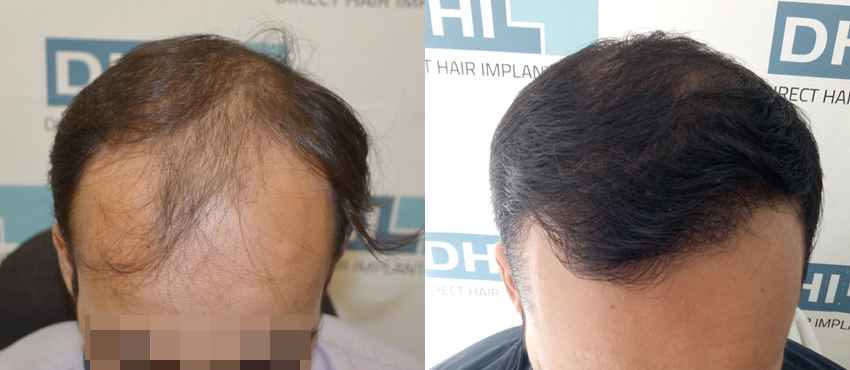 DHI before & after hair transplant results