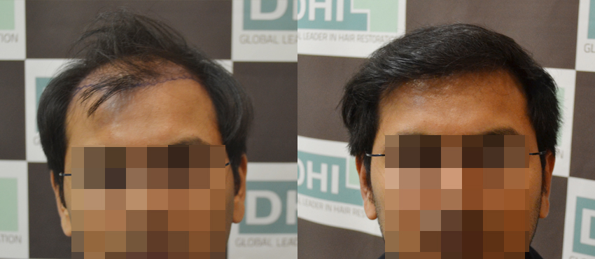 DHI before & after hair transplant results