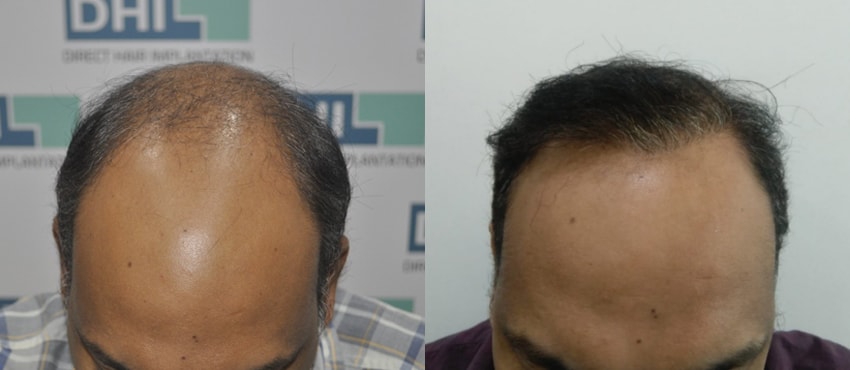 DHI before & after hair transplant results