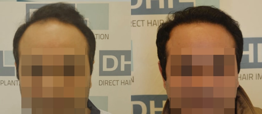 DHI before & after hair transplant results