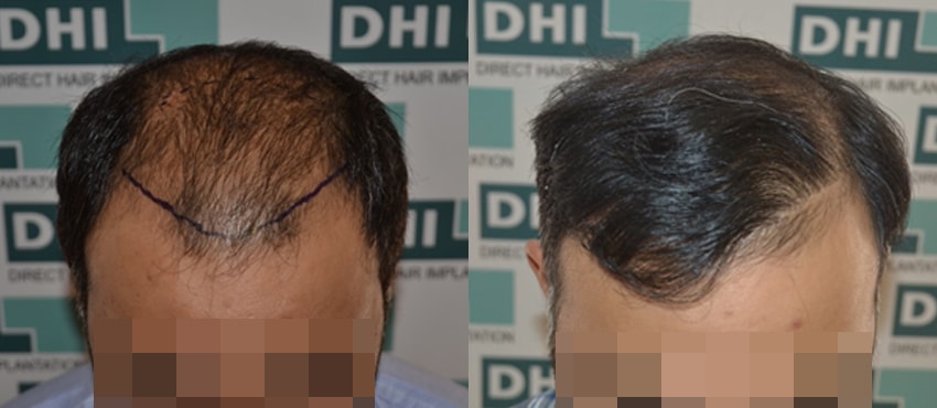 DHI before & after hair transplant results