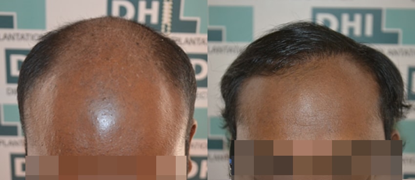 DHI before & after hair transplant results