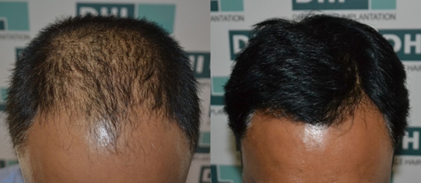 DHI before & after hair transplant results