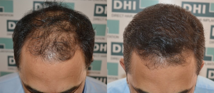 DHI before & after hair transplant results