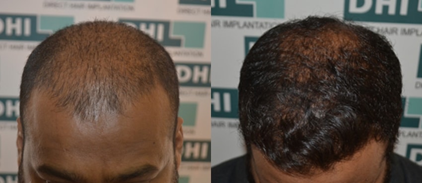 DHI before & after hair transplant results