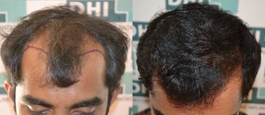 DHI before & after hair transplant results