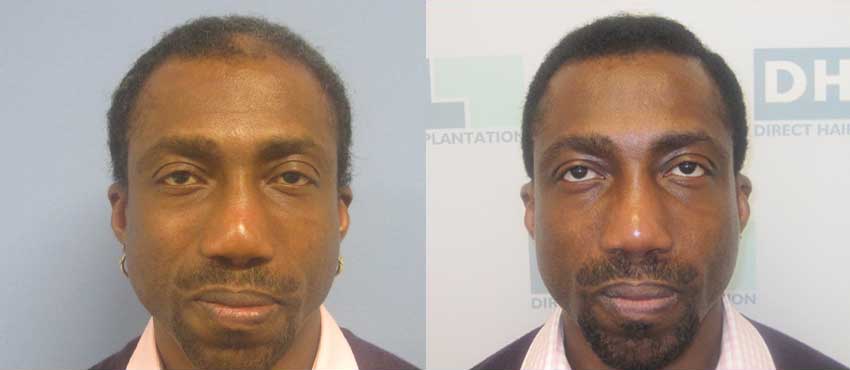 DHI before & after hair transplant results