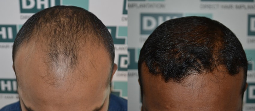 DHI before & after hair transplant results