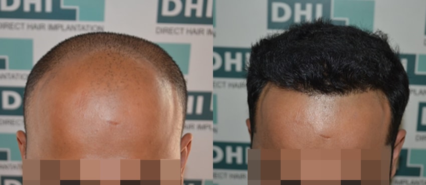 DHI before & after hair transplant results