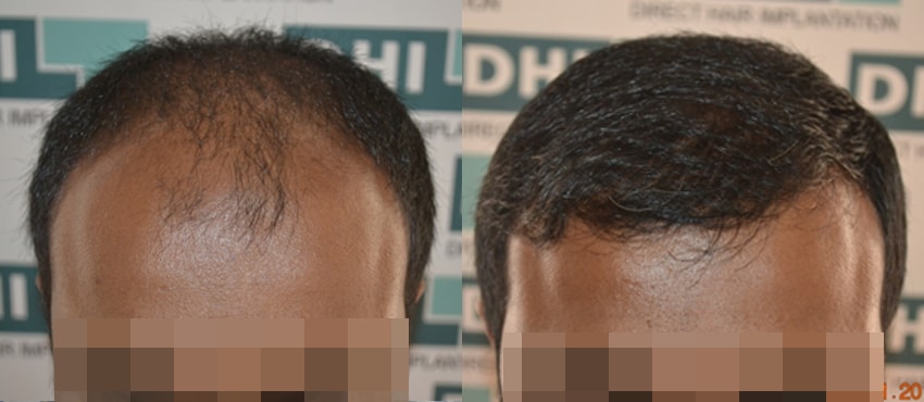 DHI before & after hair transplant results