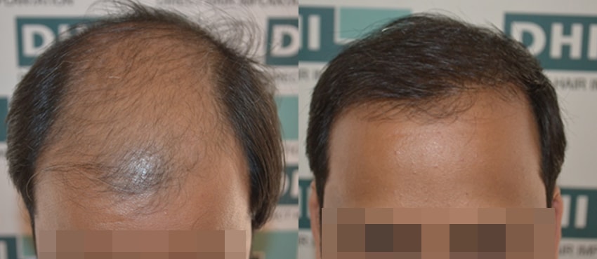 DHI before & after hair transplant results