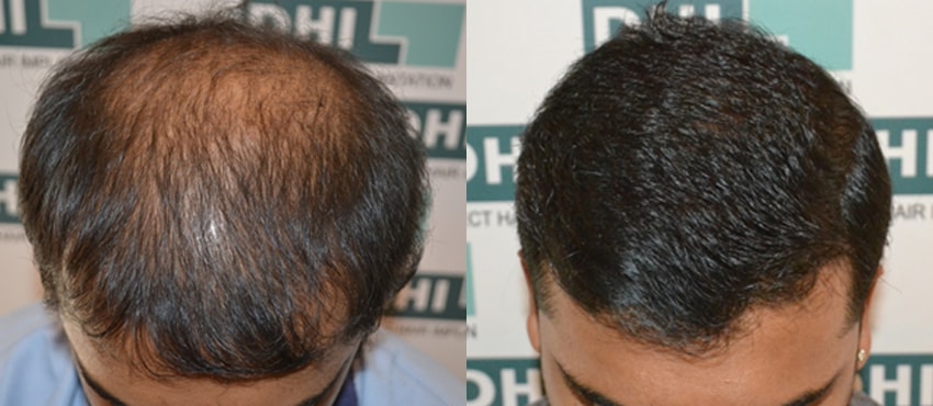 DHI before & after hair transplant results