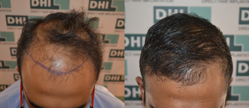 DHI before & after hair transplant results