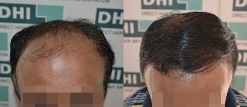 DHI before & after hair transplant results