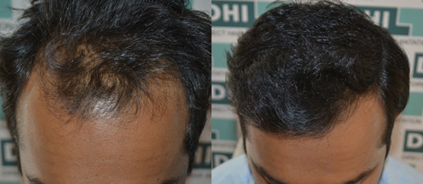 DHI before & after hair transplant results