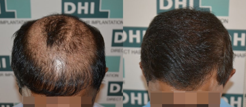 DHI before & after hair transplant results