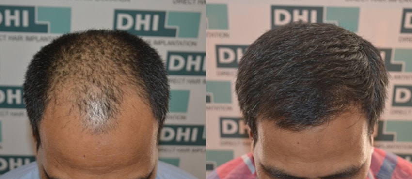 DHI before & after hair transplant results