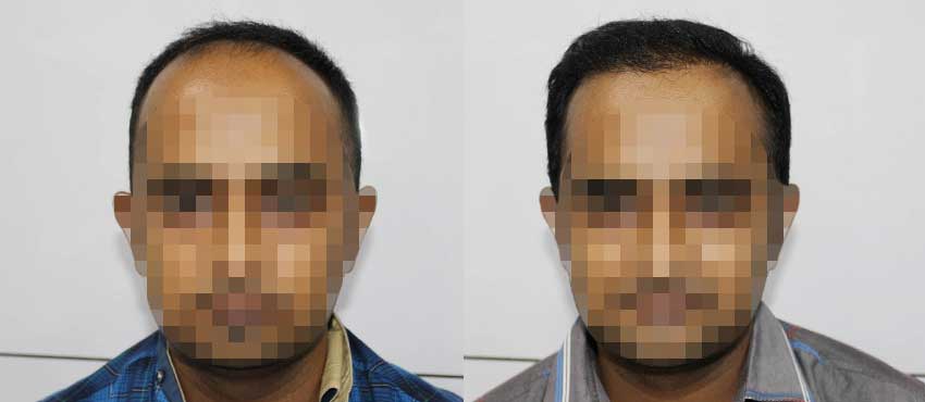 DHI before & after hair transplant results