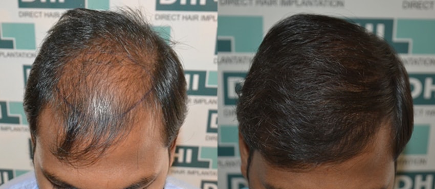 DHI before & after hair transplant results