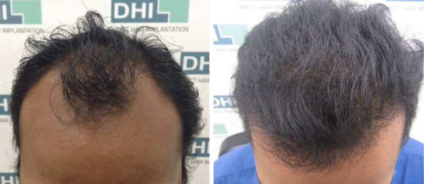 DHI before & after hair transplant results