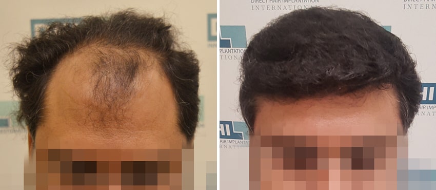 DHI before & after hair transplant results