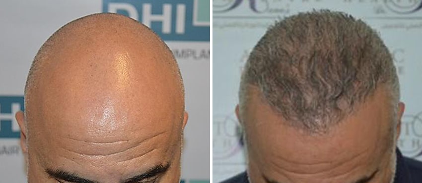 DHI before & after hair transplant results