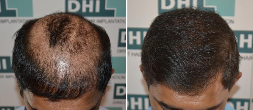 DHI before & after hair transplant results