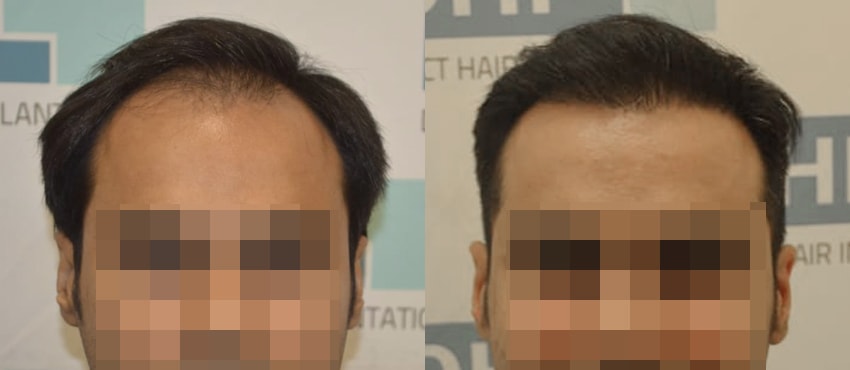 DHI before & after hair transplant results