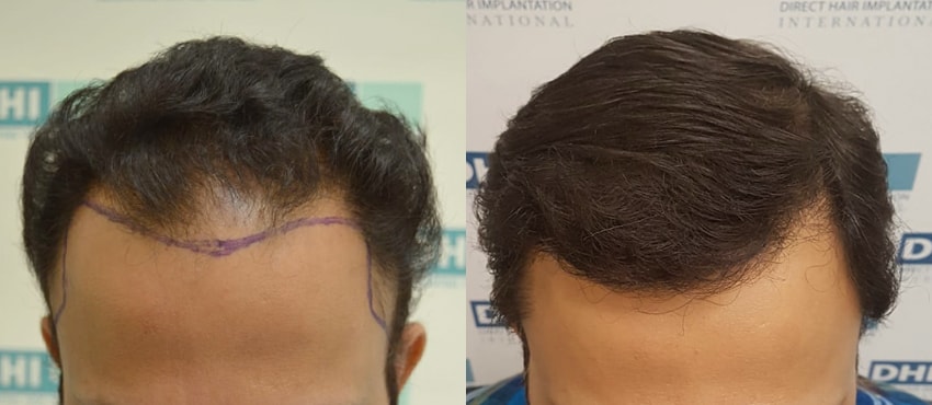 DHI before & after hair transplant results