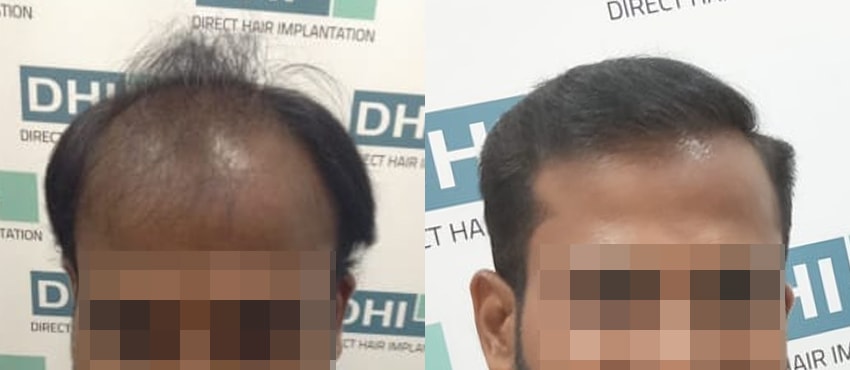 DHI before & after hair transplant results