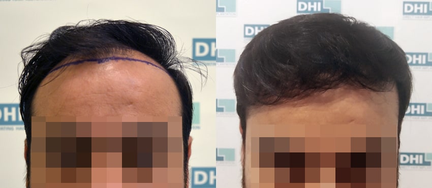 DHI before & after hair transplant results