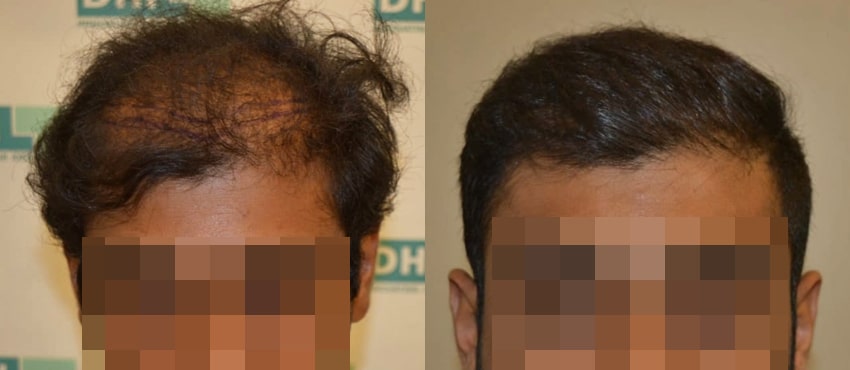 DHI before & after hair transplant results