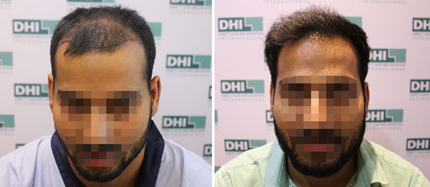 DHI before & after hair transplant results