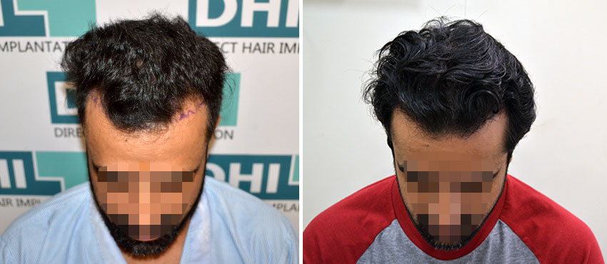 DHI before & after hair transplant results