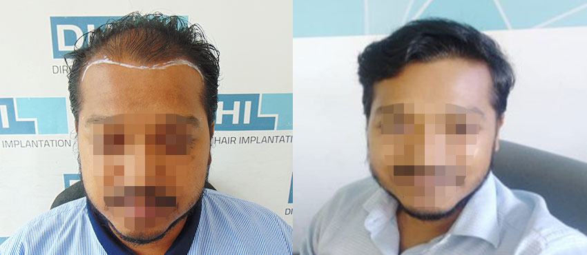 DHI before & after hair transplant results