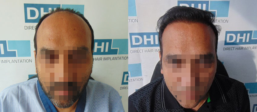 DHI before & after hair transplant results