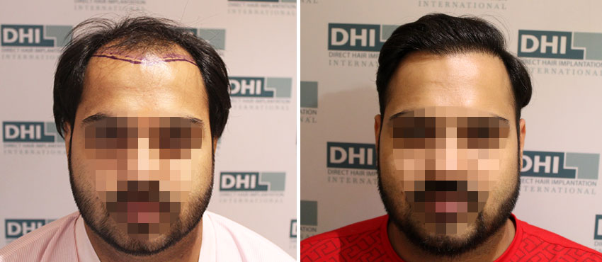 DHI before & after hair transplant results