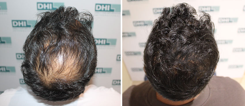 DHI before & after hair transplant results