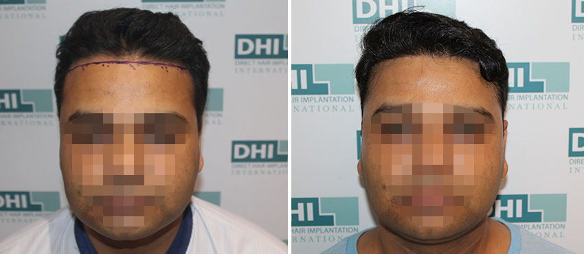 DHI before & after hair transplant results